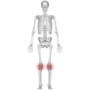 Anterior view of a skeletal knee. Massage helps treat chronic pain from osteoarthritis of the knees.